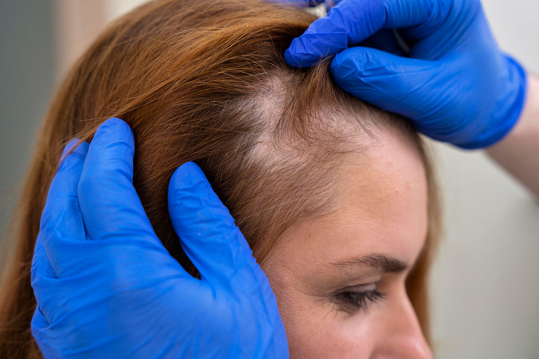 Haarausfall in der Stillzeit: Ursachen und Behandlung